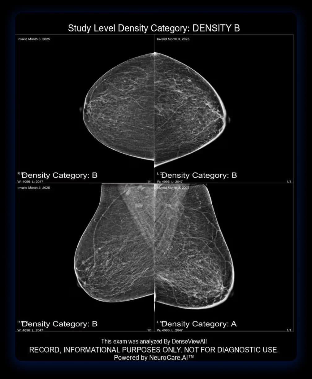 DenseViewAI, automated breast density assessment