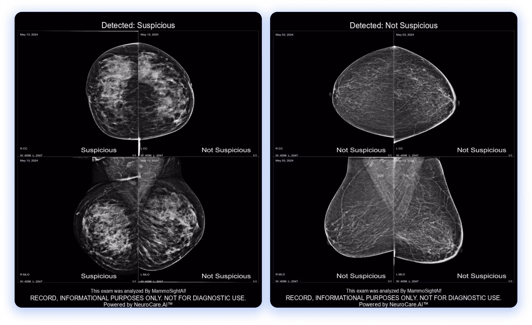 MammoSightAI, AI-powered early breast cancer detection