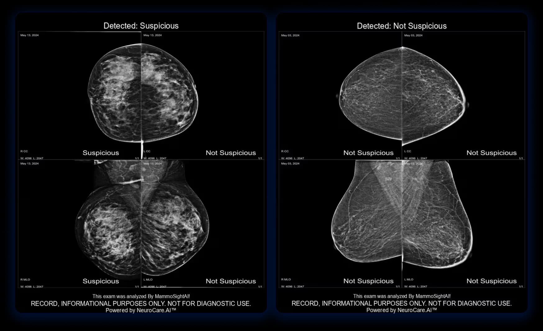 MammoSightAI, AI-powered early breast cancer detection